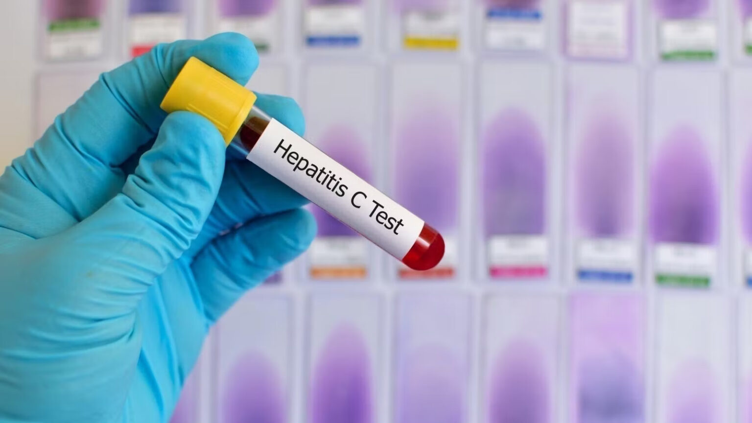 ¿Cómo saber si tienes hepatitis B o C? Síntomas, contagio y detección temprana